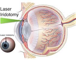 Iridotomia a laser para Glaucoma