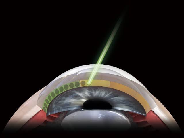 Laser para Glaucoma (SLT - Trabeculoplastia seletiva)